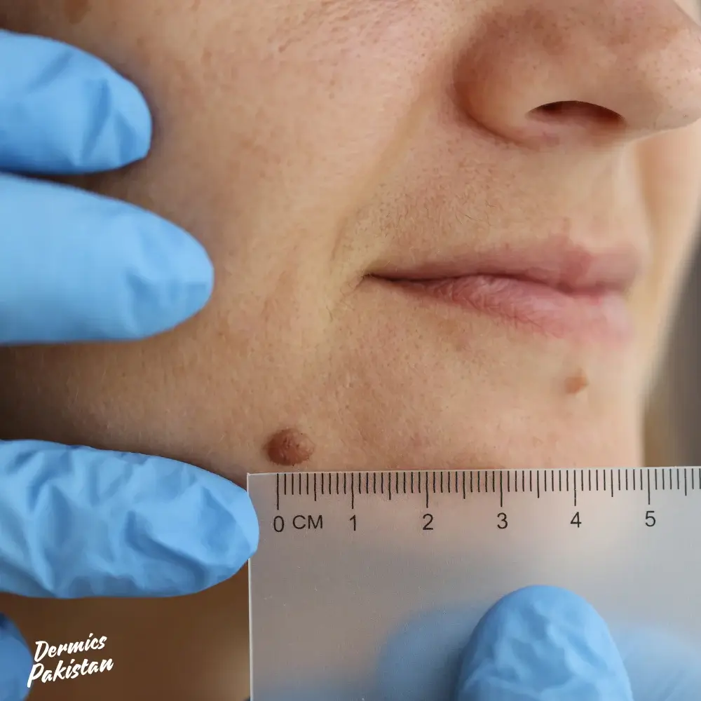 Fractional CO2 Laser for Mole and wart Removal service